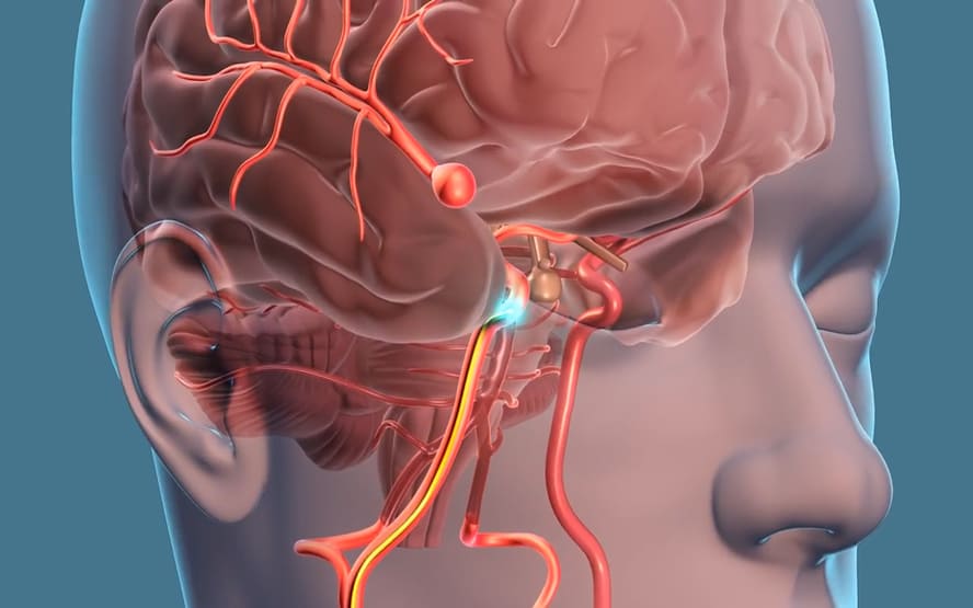 Aneurismas cerebrais o que causa e como tratar? 