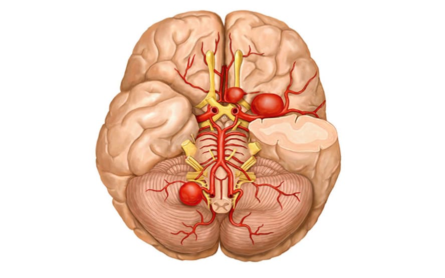 <span style="font-size: 8pt; color: #999999;">Aneurismas cerebrais o que causa e como tratar? </span>