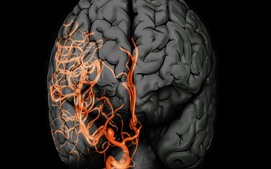 <span style="font-size: 8pt; color: #999999;">Aneurismas cerebrais o que causa e como tratar? </span>