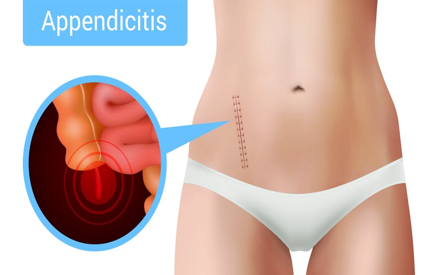 Causas da apendicite, diagnóstico e tratamento