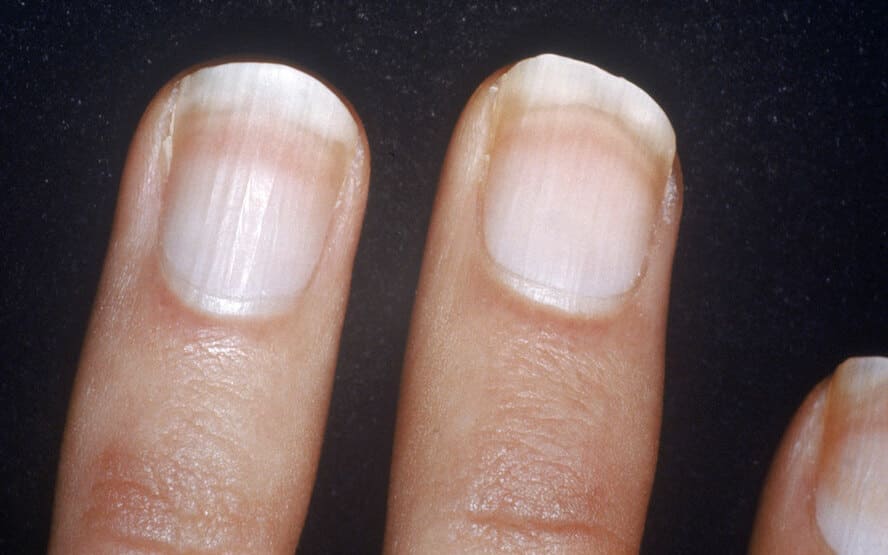 Distúrbios das unhas: o que as unhas dizem sobre sua saúde