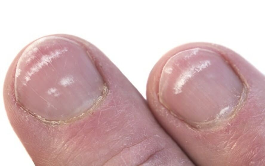 Distúrbios das unhas: o que as unhas dizem sobre sua saúde