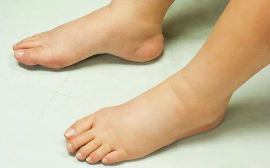 Descubra o segredo para reduzir o edema. %contagem (título)% O que fazer se você tem edema