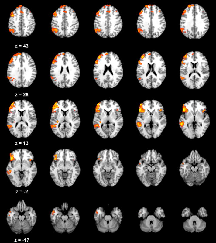 Aging brain