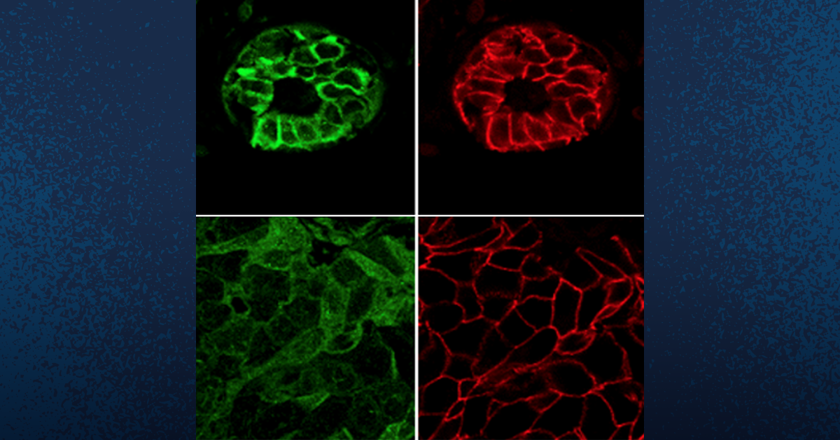 The Double-Edged Treatment: How TYK2 Inhibitors Increase Breast Cancer Metastasis