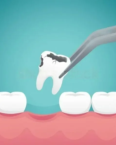 EXTRACCION DENTAL