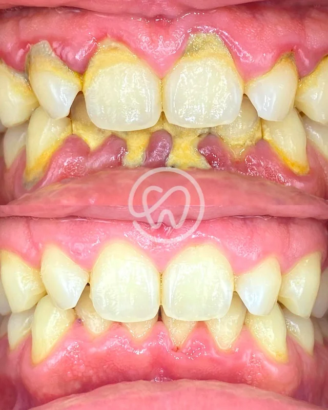 LIMPIEZA DENTAL FULL-PRO