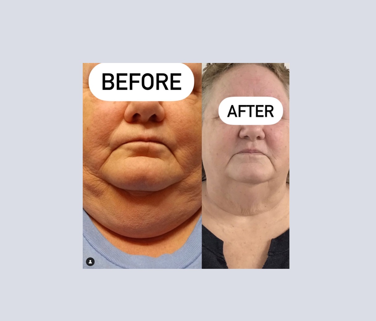Client Achieves Remarkable Weight Loss and Neck Transformation in Just 5 Weeks!
