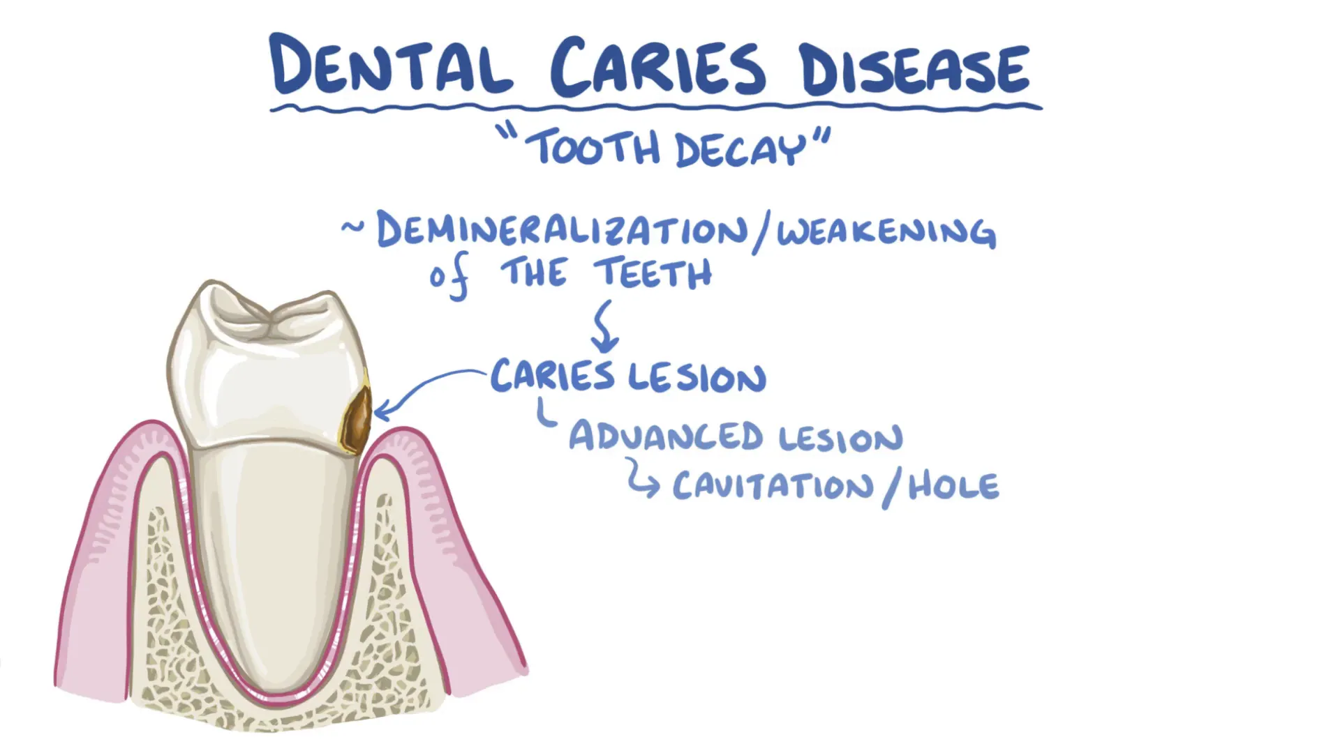 Formation of cavity on tooth surface due to decay