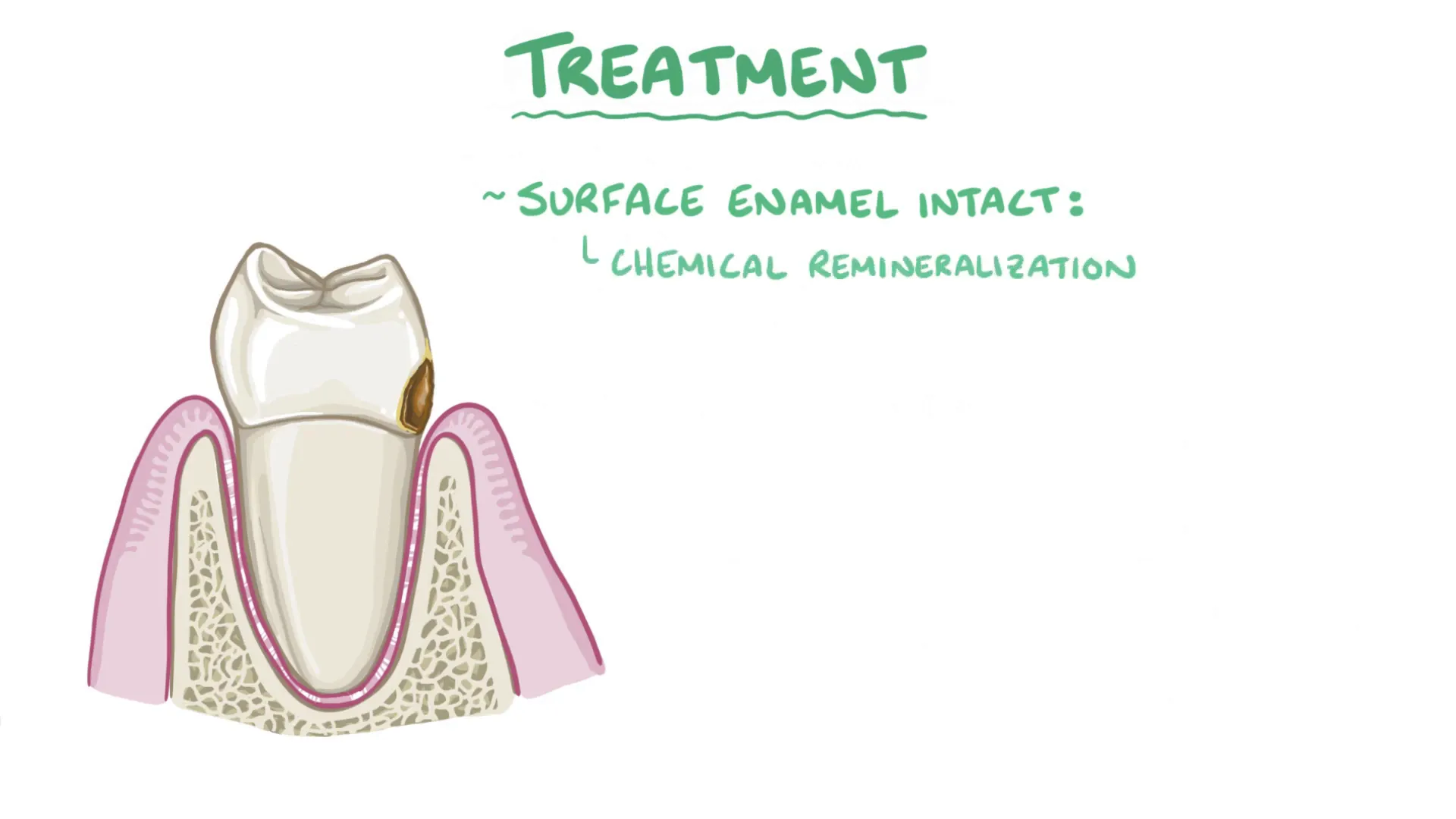 Dental treatment including fluoride application and fillings