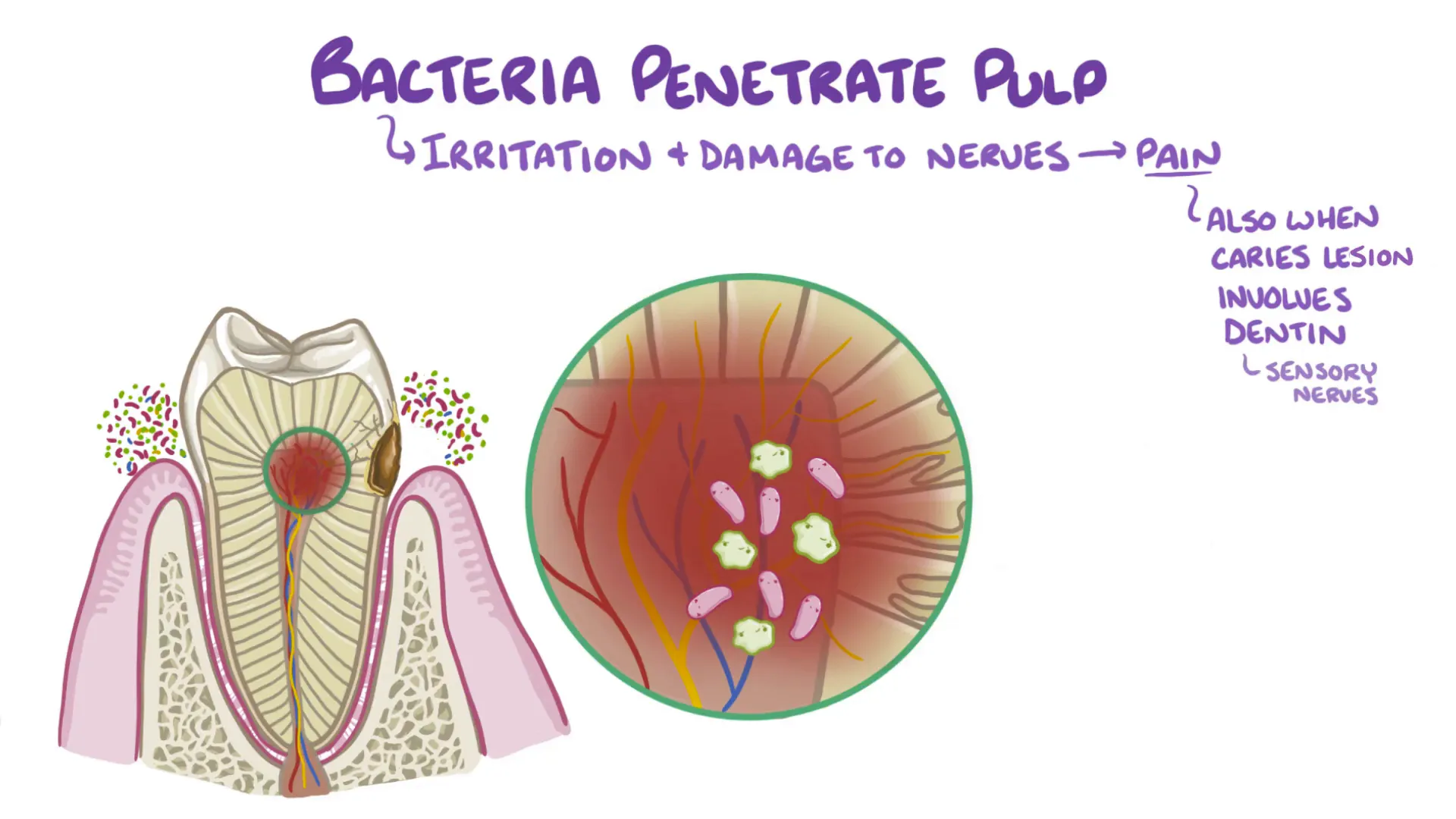 Advanced tooth decay reaching pulp causing pain and inflammation