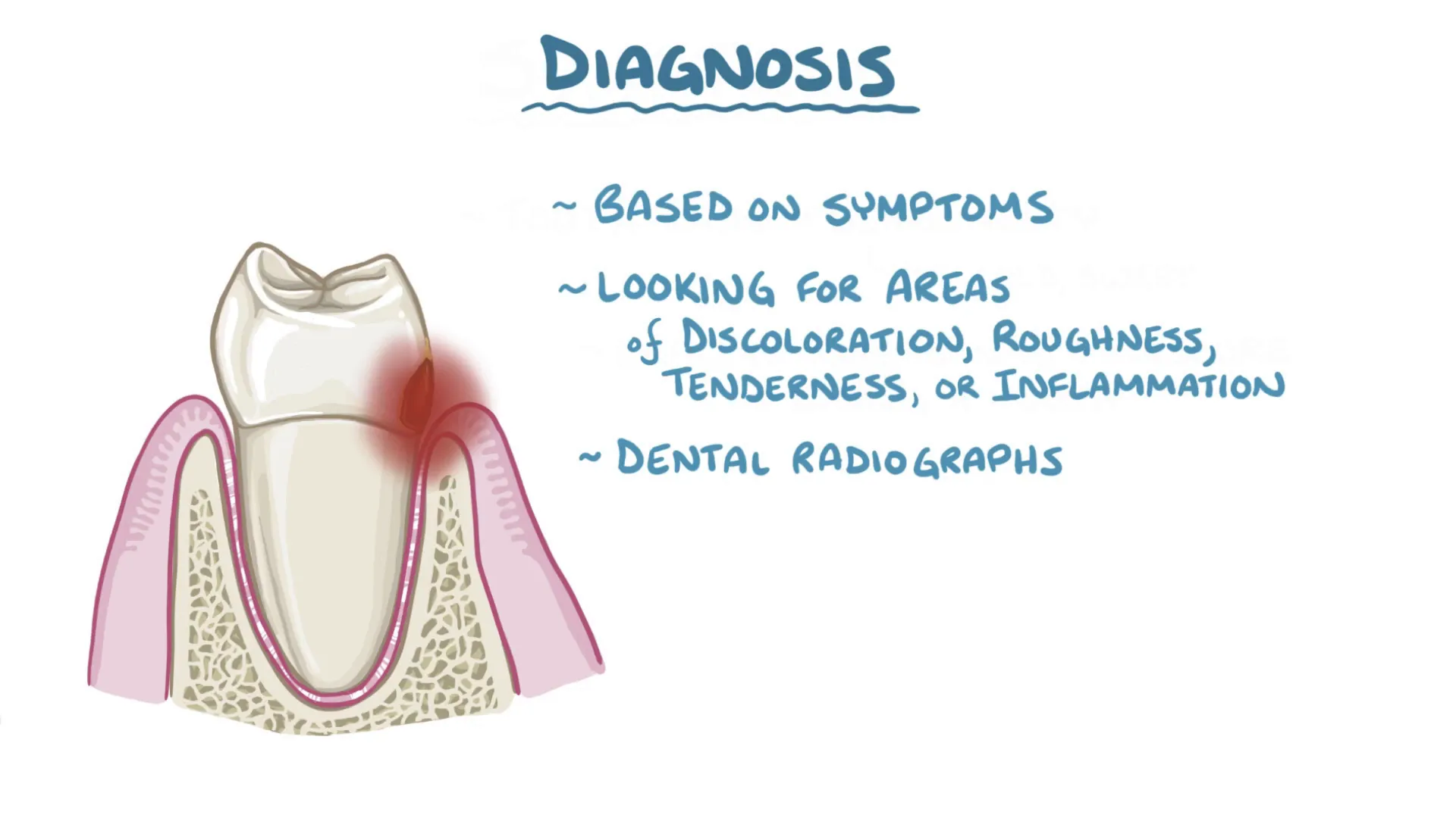 Dental X-ray showing cavities in teeth