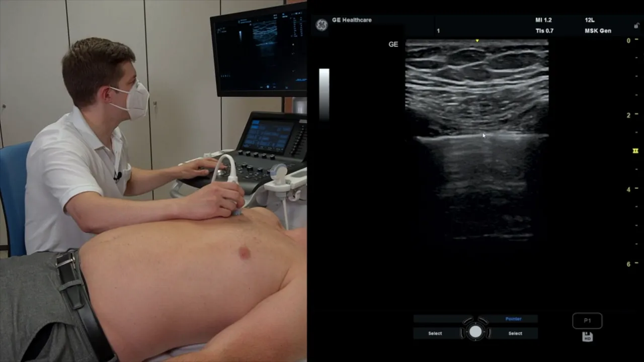 Pleuralinie, Interkostalmuskel und Pectoralis sichtbar