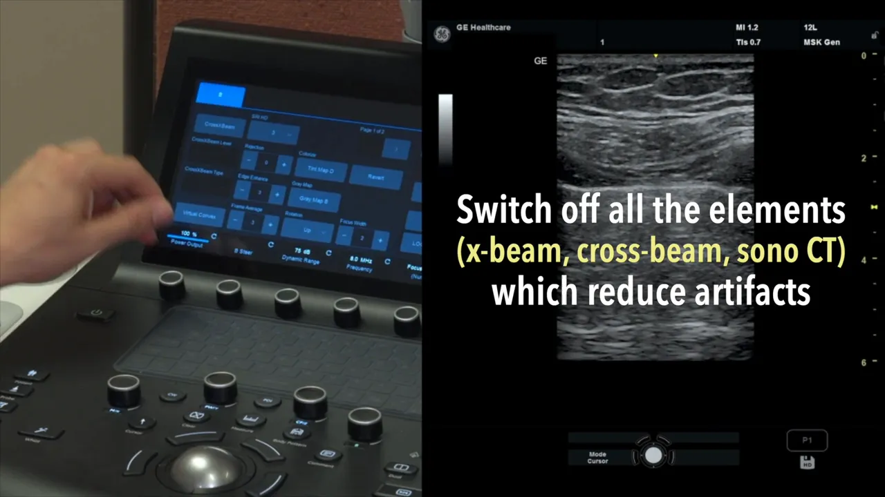 Cross X Beam wird ausgeschaltet zur besseren Darstellung von Artefakten