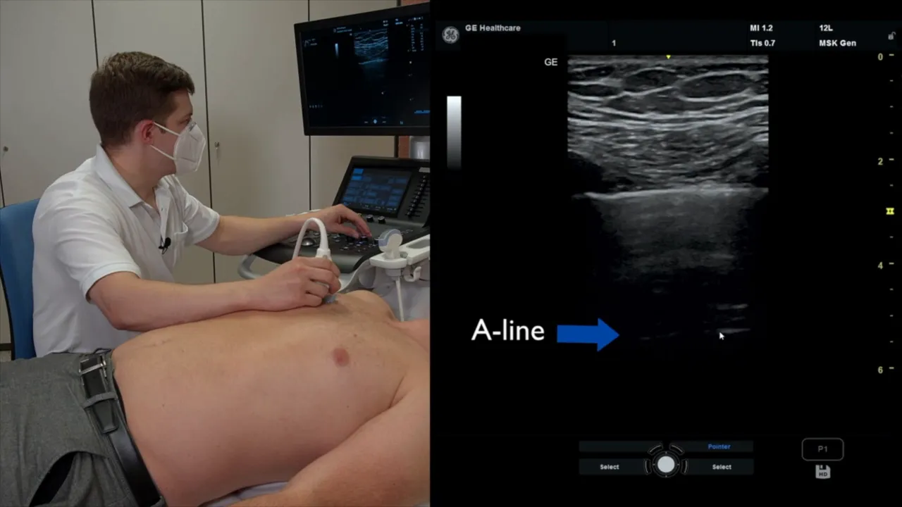 A-Lines als spiegelnde Artefakte unterhalb der Pleuralinie
