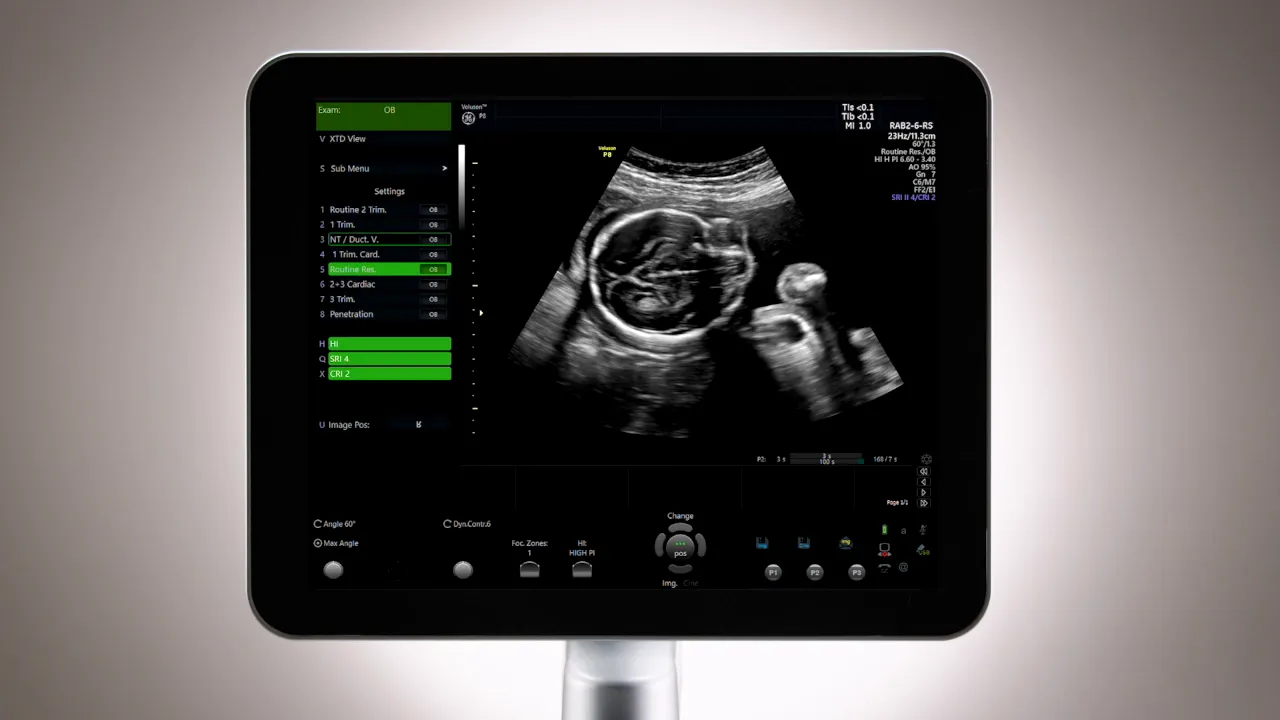 Voluson P8 display showing a clear 2D fetal ultrasound image suitable for demonstrating frequency and harmonic imaging
