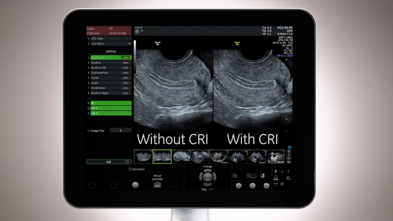 Klares Side‑by‑Side Ultraschallbild auf Monitor: ohne CRI links, mit CRI rechts