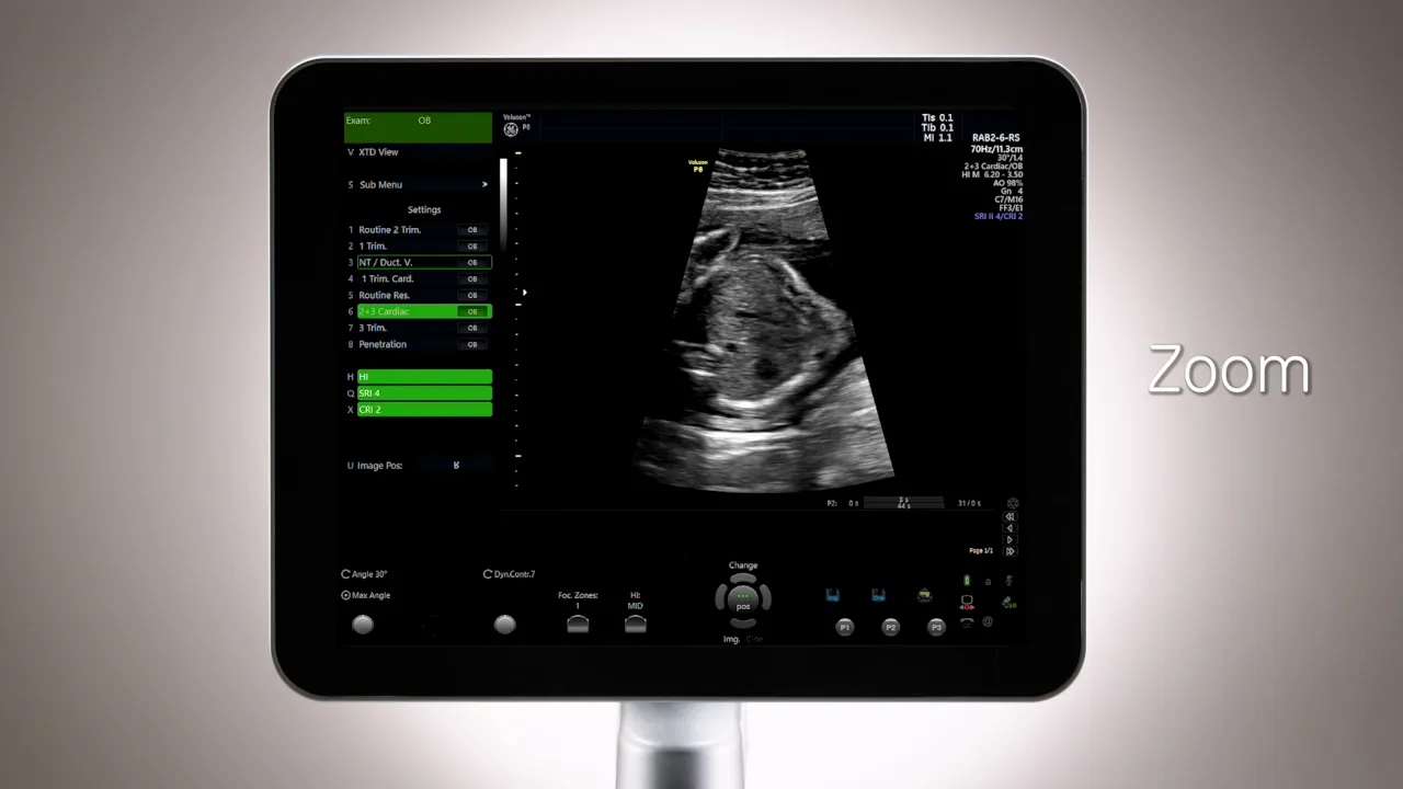 Voluson P8 Monitor mit aktivem Zoom und vergrößerter Ultraschallansicht