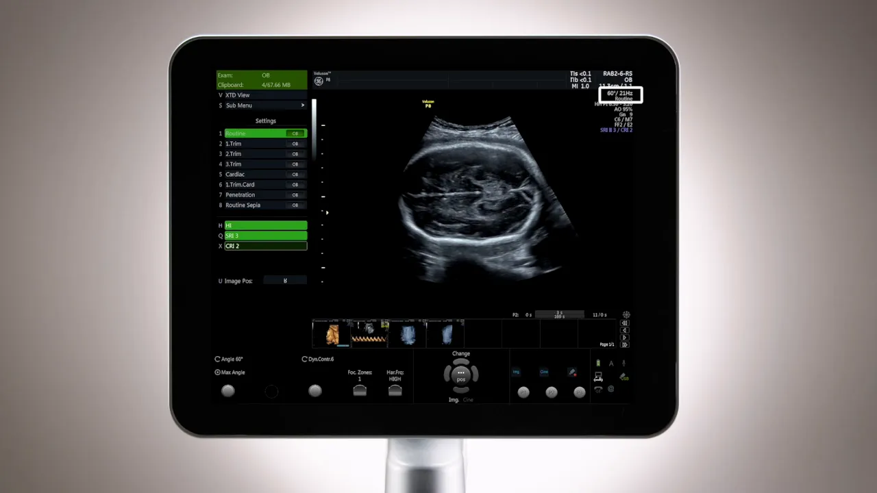 Voluson P8 Monitor mit Ultraschallbild und sichtbaren Fokus-Einstellungen