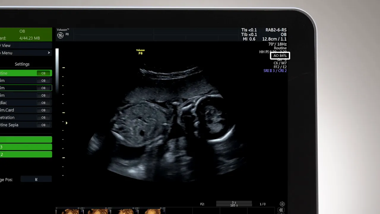Nahaufnahme des Voluson P8 Monitors mit hervorgehobener Acoustic Output Anzeige (AO 84%).