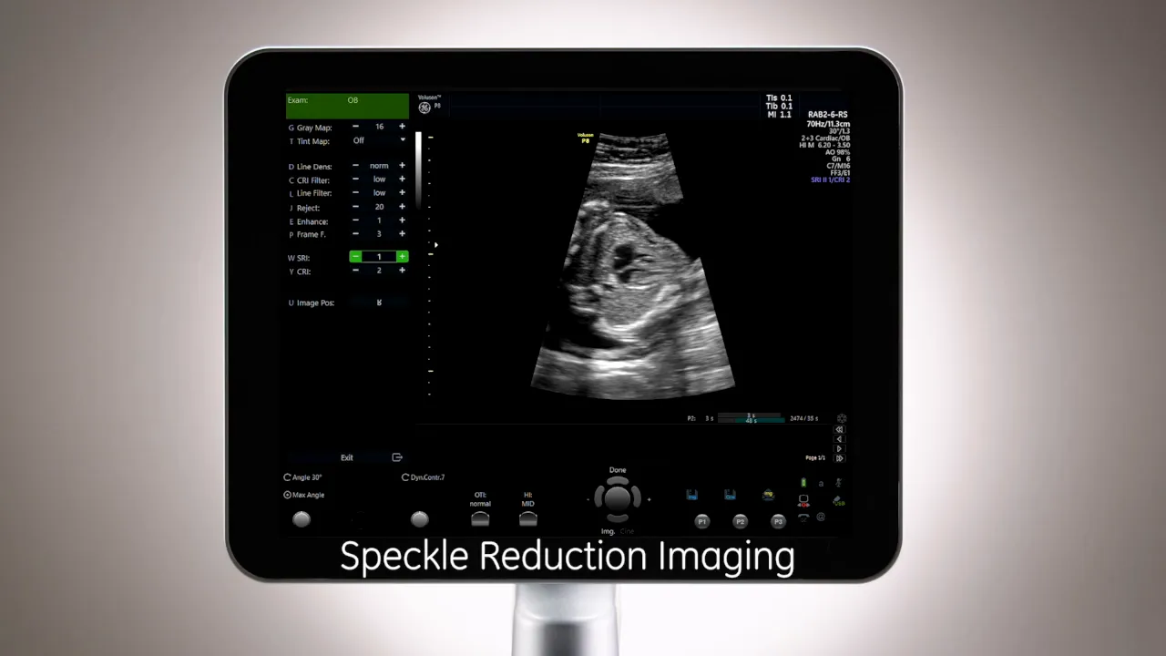 Voluson P8 Bildschirm mit aktivierter Speckle Reduction Imaging (SRI) Einstellung und Ultraschallbild