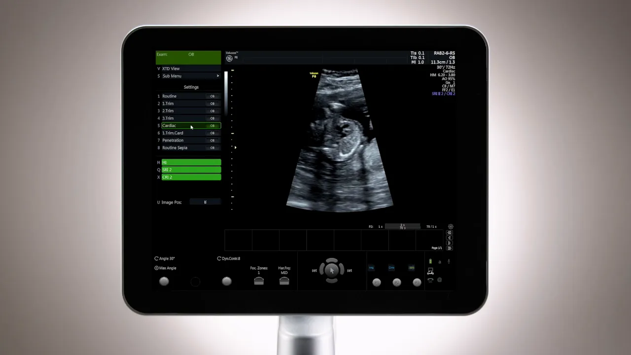 Voluson P8 Monitor mit deutlich sichtbarem B‑Mode Ultraschallbild und Preset‑Menü