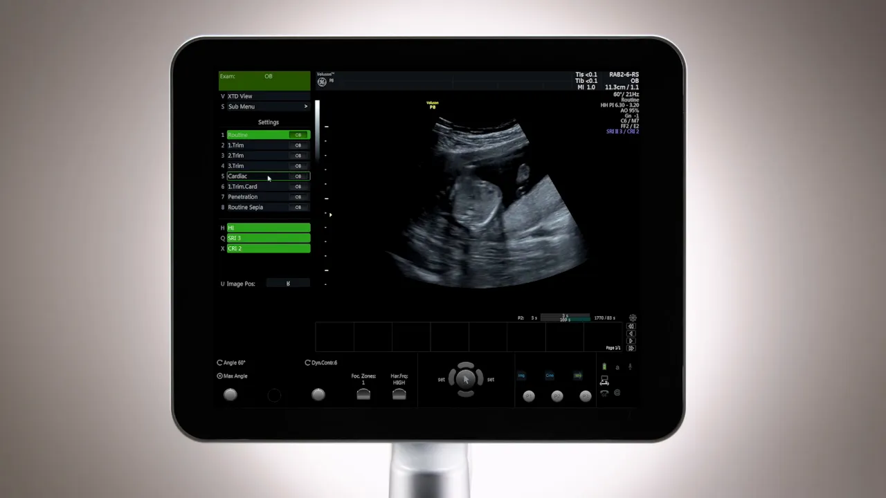 Voluson P8 Bildschirm zeigt Preset‑Liste links und ein scharfes 2D‑Ultraschallbild rechts