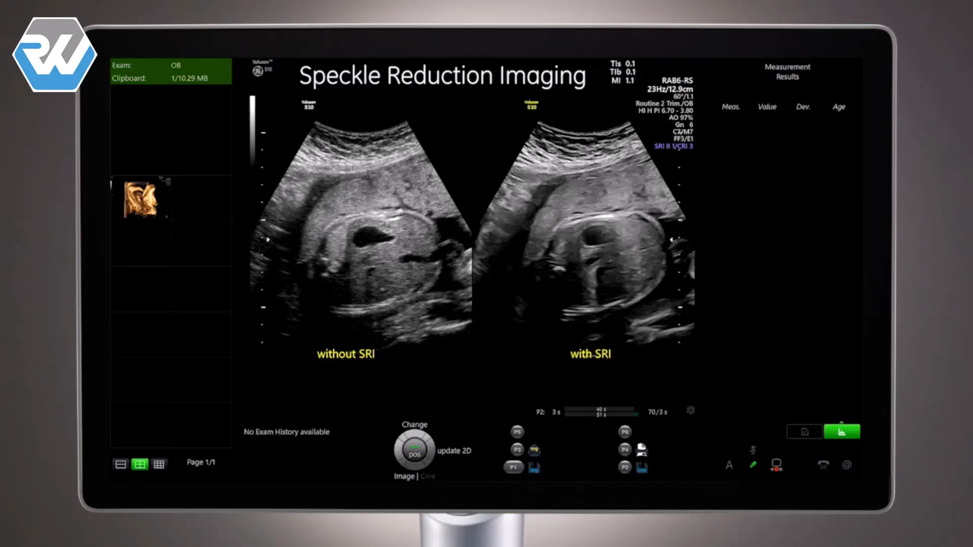 Aktivierung der Speckle Reduction Imaging