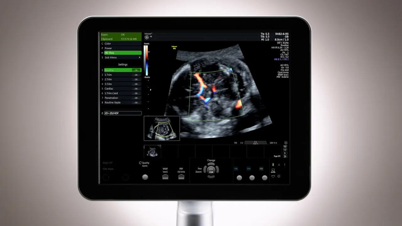 Voluson P8 Monitor mit Color Doppler (HD Flow) und Preset‑Menü