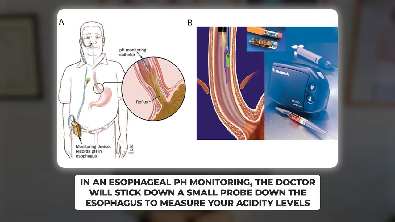 Esophageal pH monitoring probe placement
