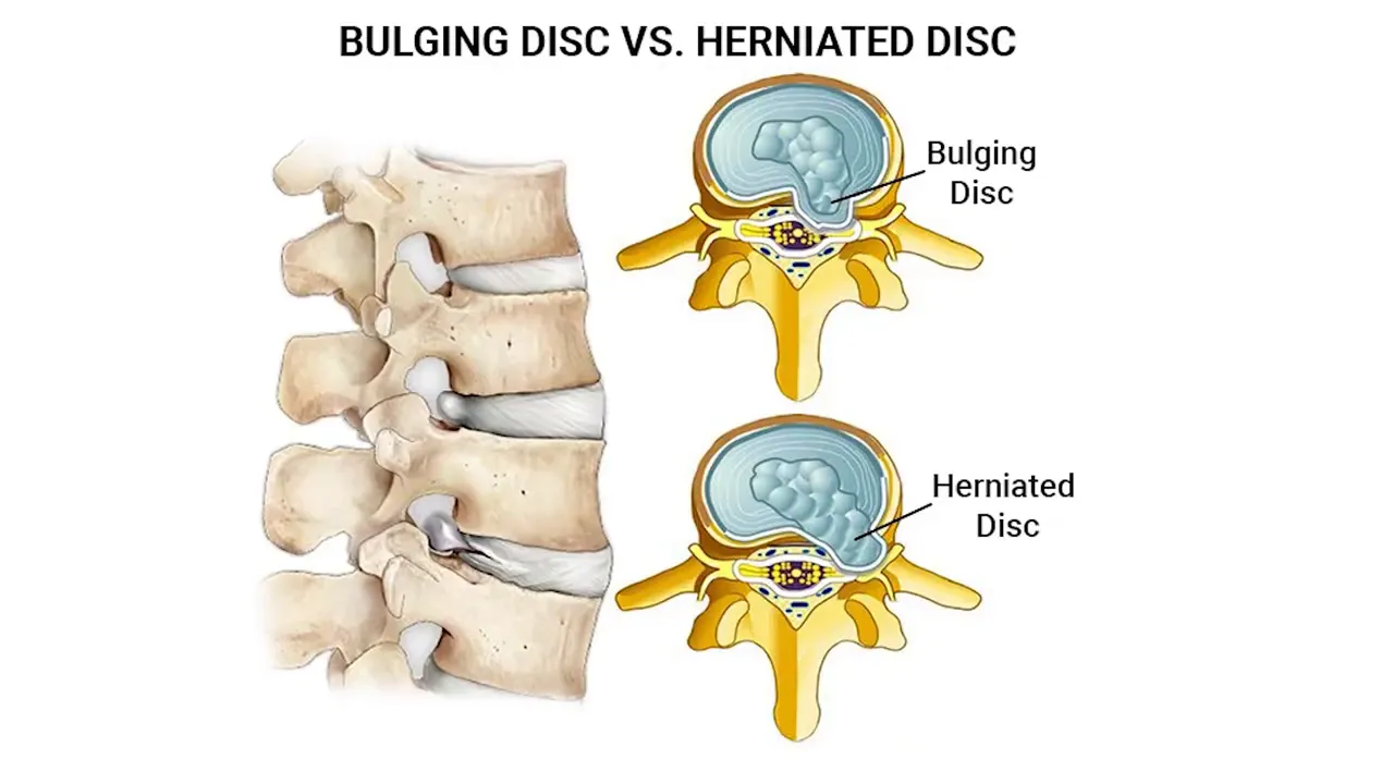 Doctor pointing to MRI image and discussing a small herniation