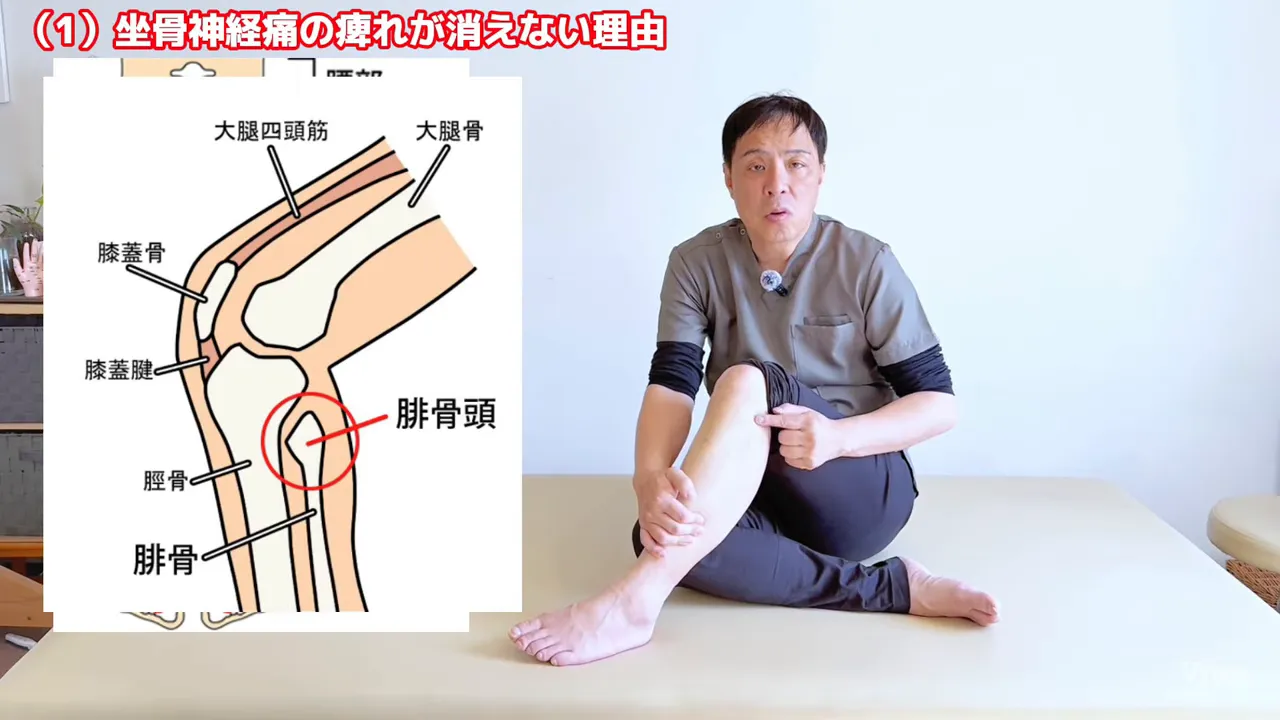 腓骨頭まわりを強調した坐骨神経の走行図（外側ラインが硬いと引っ張られる）