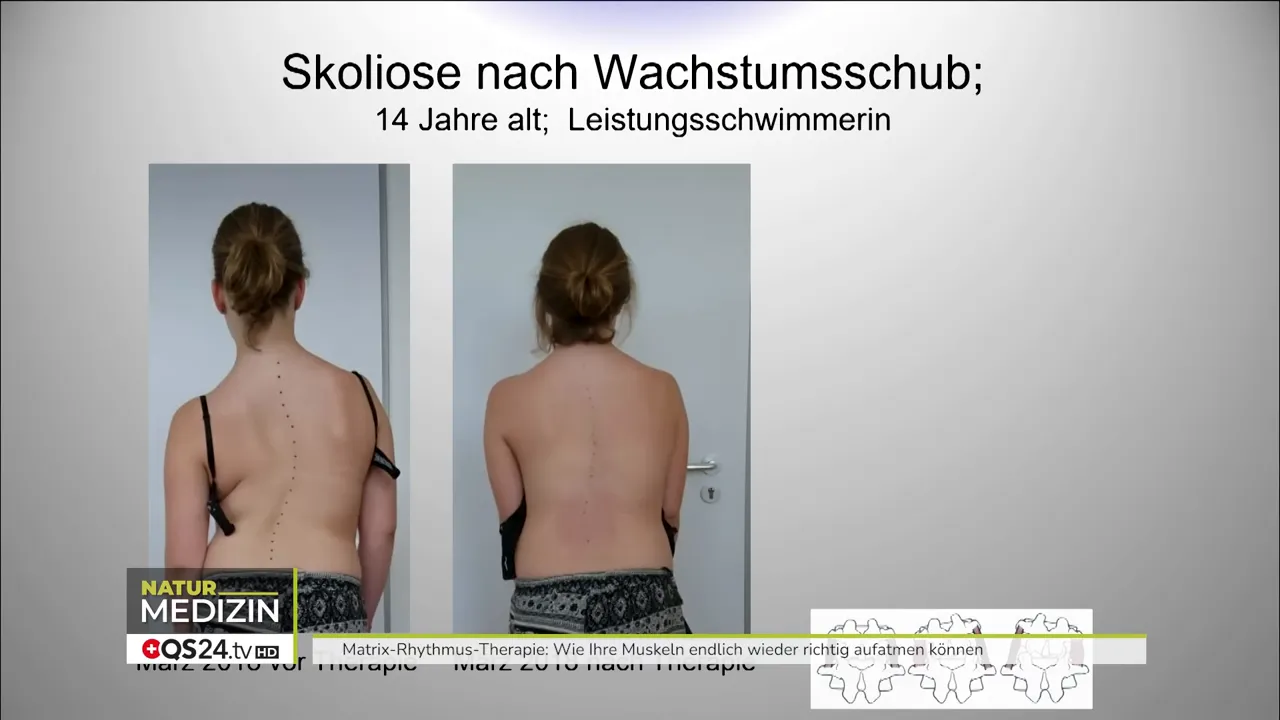 Wie Ihre Muskeln wieder aufatmen können - Interview mit Dr. Ulrich Randoll, Begründer der Matrix‑Rhythmus‑Therapie 5 Zwei Rückenfotos einer jungen Patientin nebeneinander – links vor der Behandlung, rechts nach der Behandlung (Skoliose‑Vergleich).