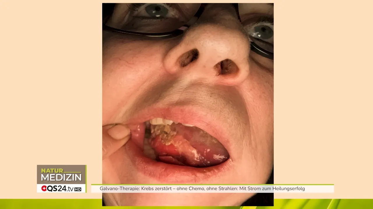 Nach der Behandlung: Nekrosen und ablösendes Tumorgewebe