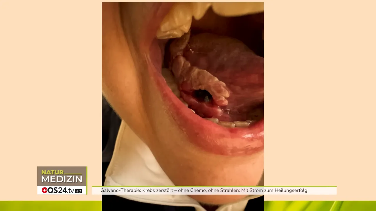 Zungenkarzinom: blumenkohlartige Wucherung vor Behandlung