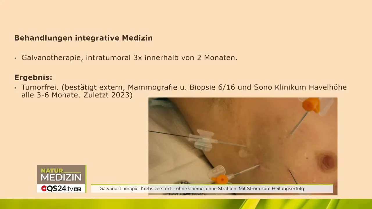 Brusttumor: vier Nadel-Elektroden, zwei sitzen im Tumor