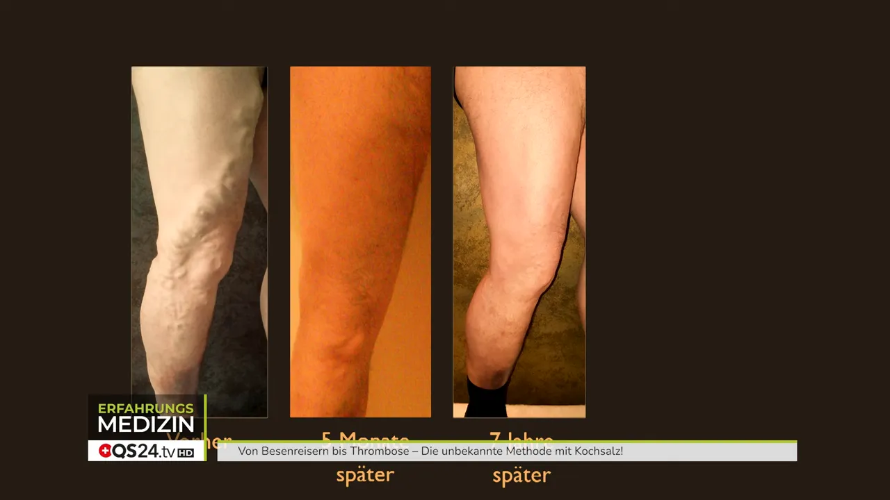 Braune Verfärbung am Schienbein als Spätfolge