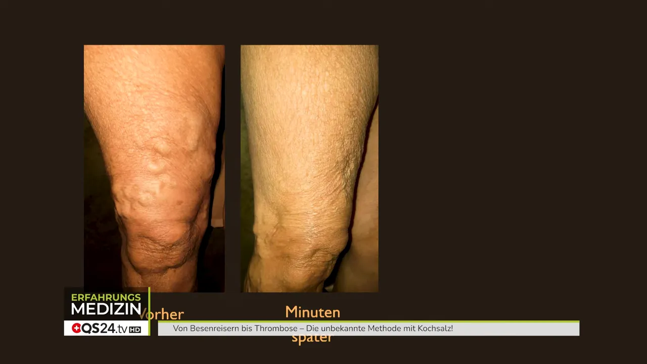 Soforteffekt: Krampfader zieht sich zusammen