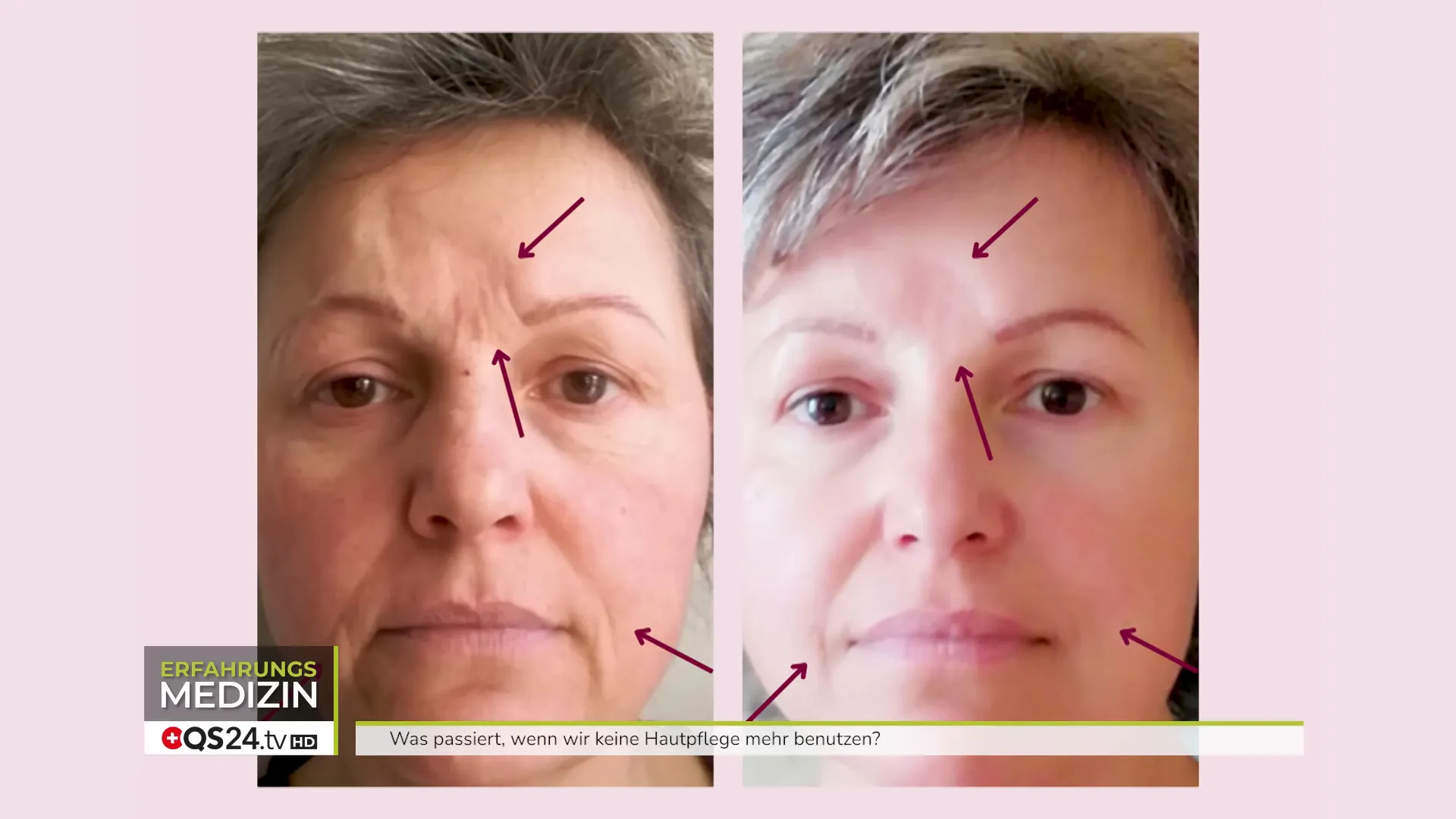 Fallbeispiel: Narbenreduktion nach 1,5 Jahren