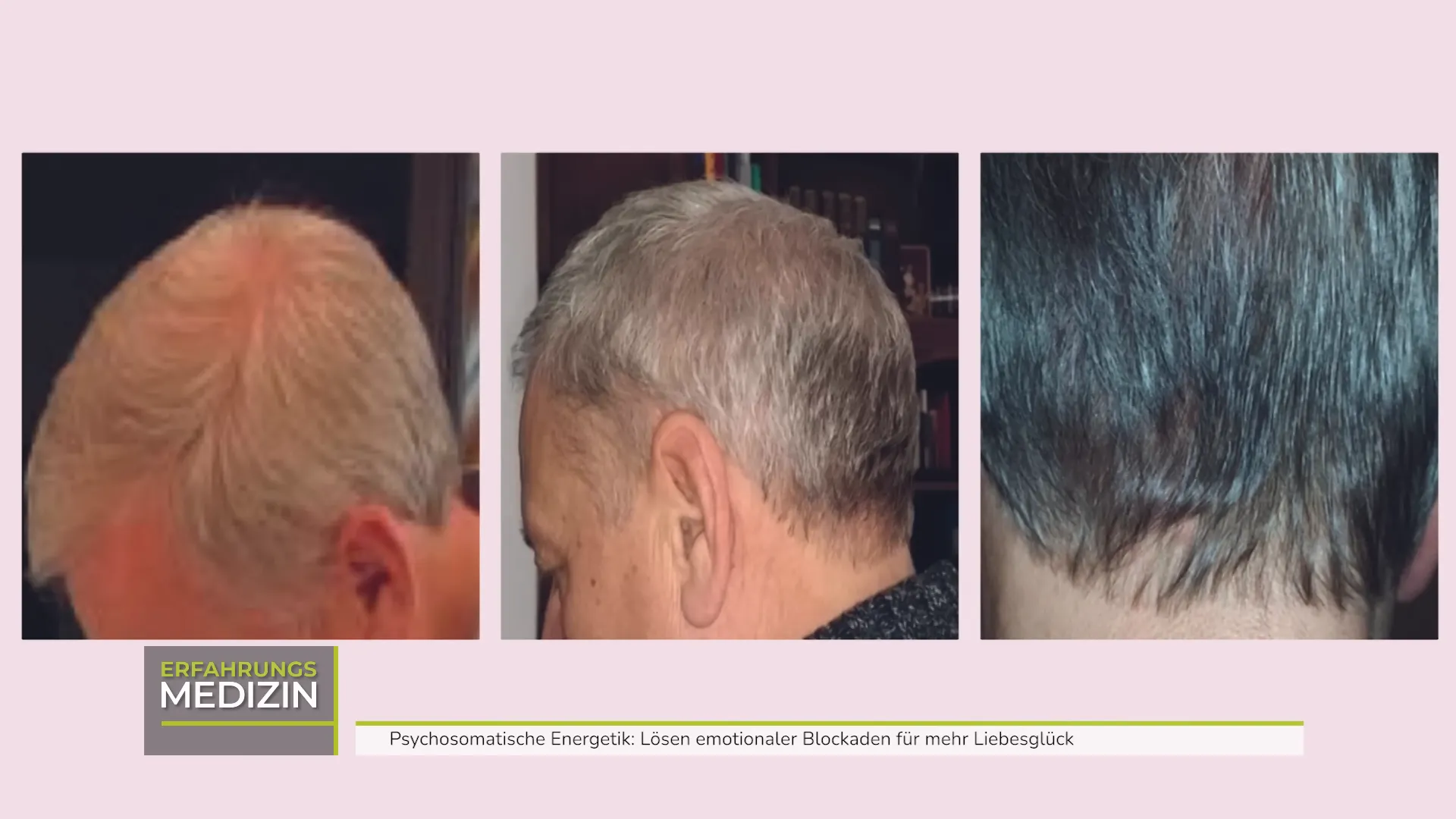 Vorher-Nachher bei Psoriasis am Hinterkopf