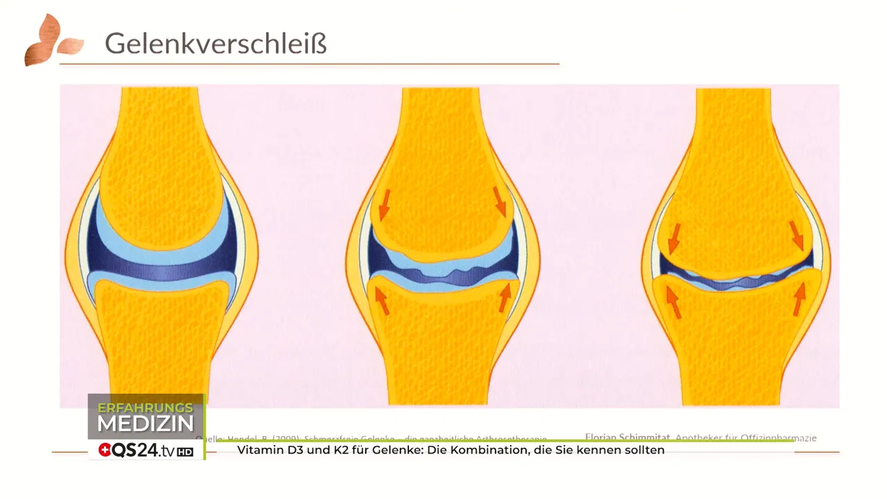 Gelenkverschleiß: Knorpel, Bänder, Knochen – das ganze Kompartiment behandeln