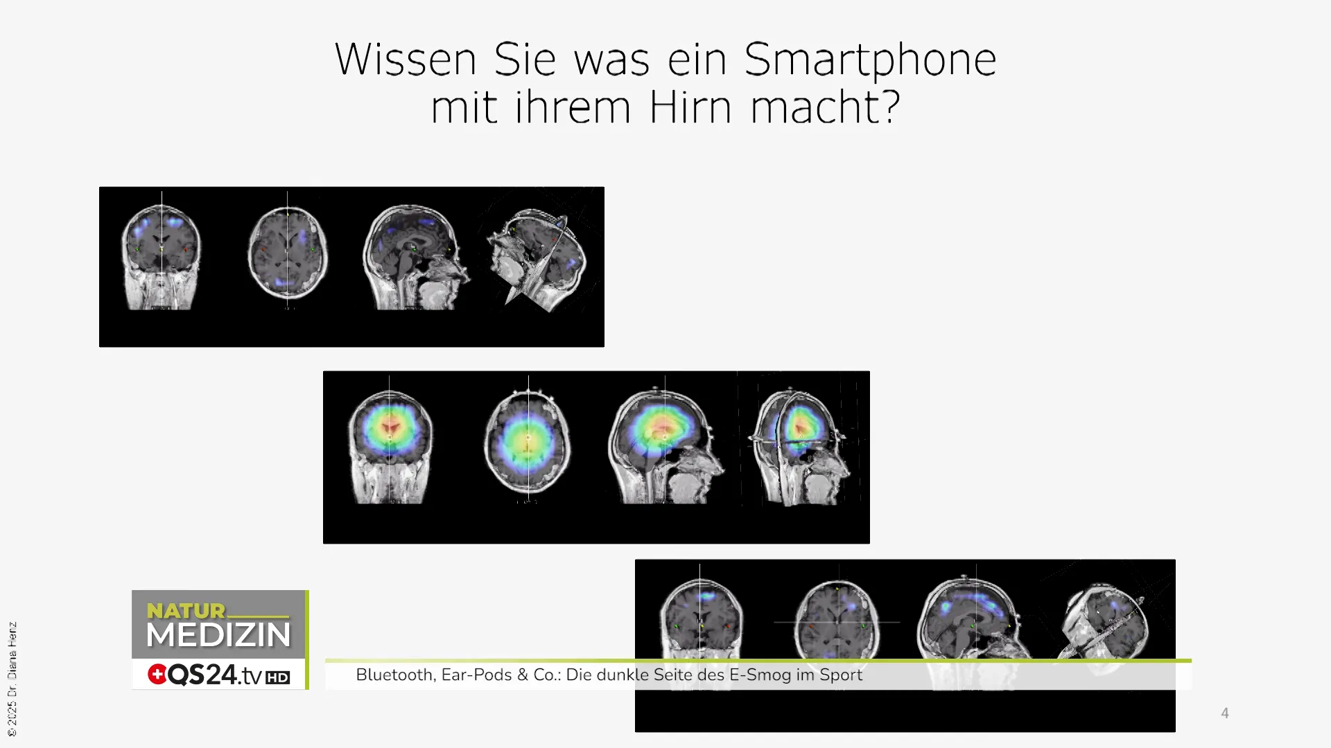 EEG‑Auswertung: Stressaktivierung durch iPhone‑Exposition