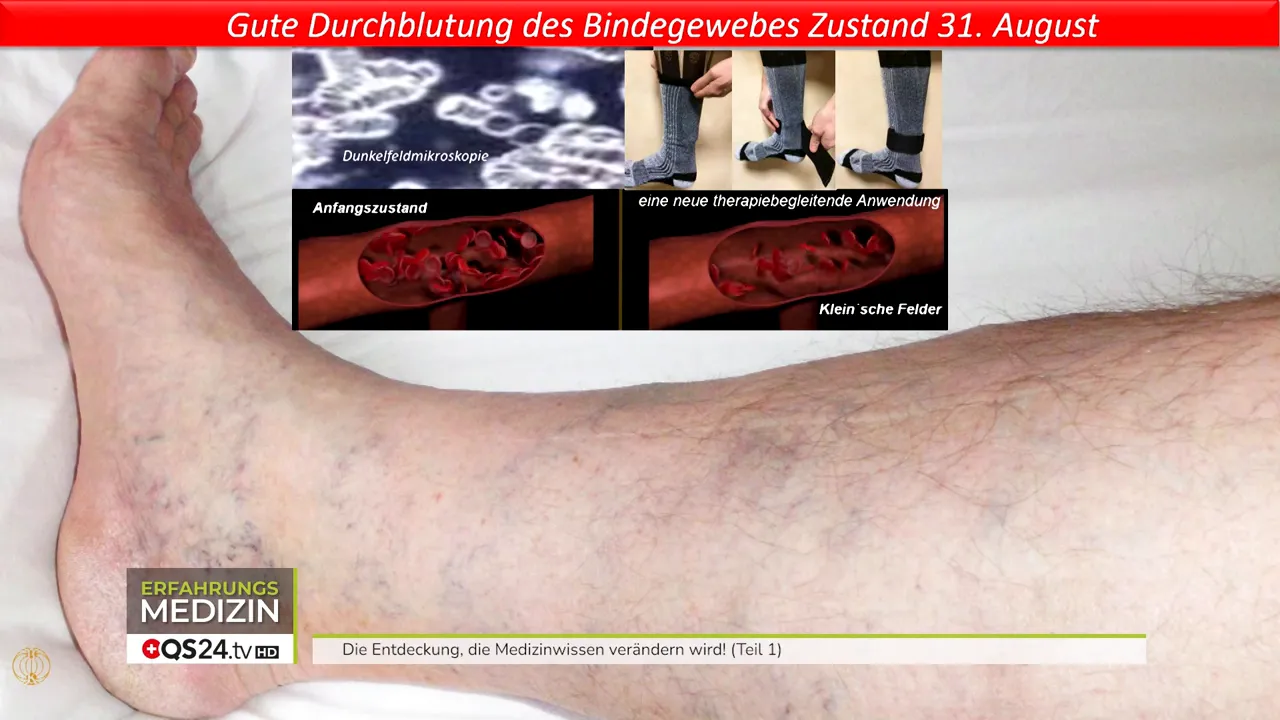 Vorher/Nachher: Rückbildung von Besenreisern in vier Wochen