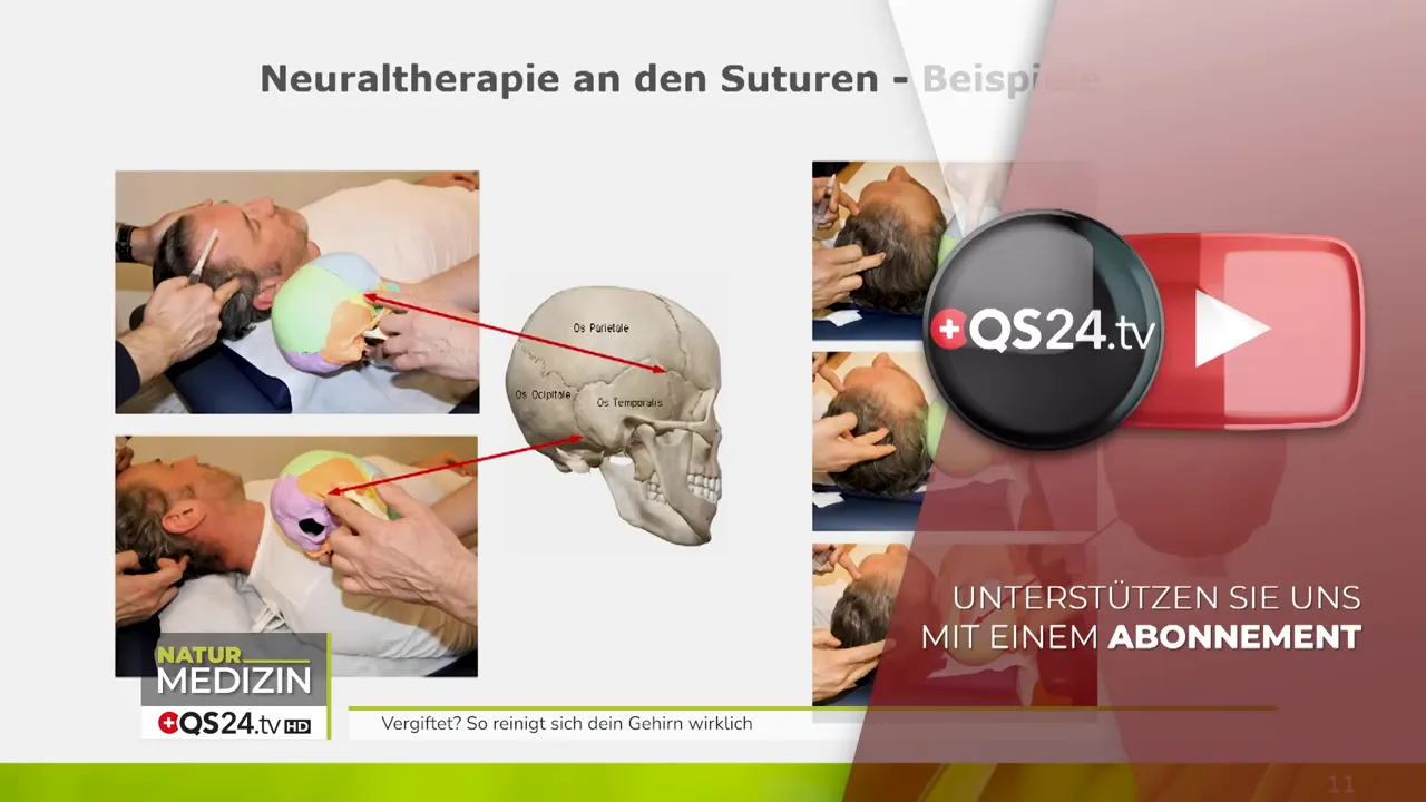 Beispielbilder zur Behandlung an den Suturen (Schädel- und Atemunterstützung) für das glymphatische System