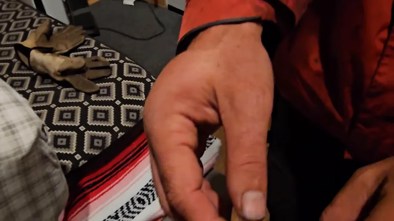 Remote island homestead: season finale — part 2 - swollen hand ice pack after winch accident