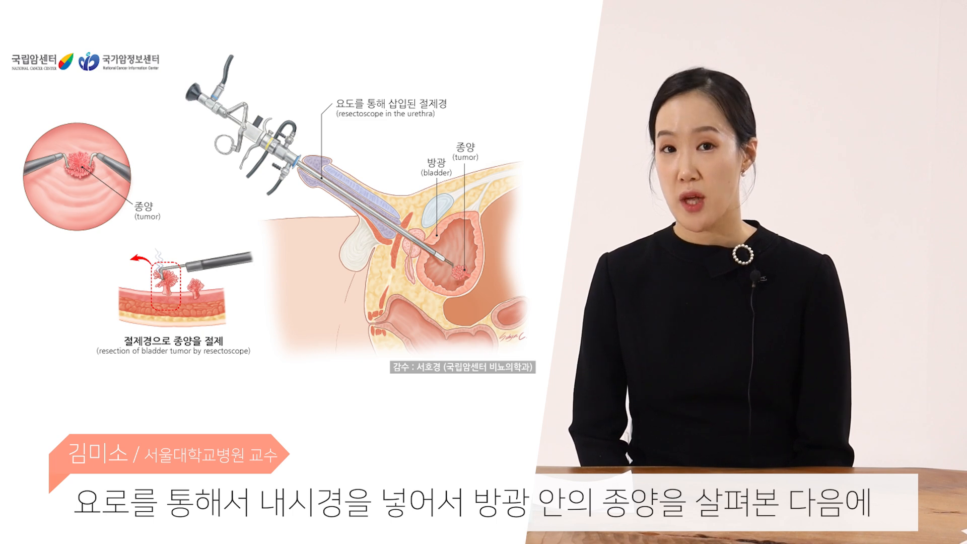 경요도 방광 종양 절제 수술