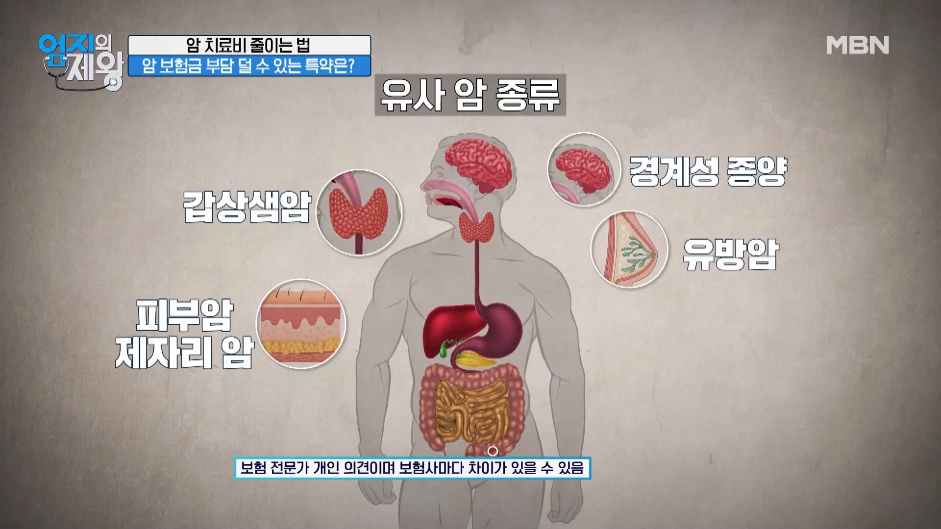 유사암 개념 설명