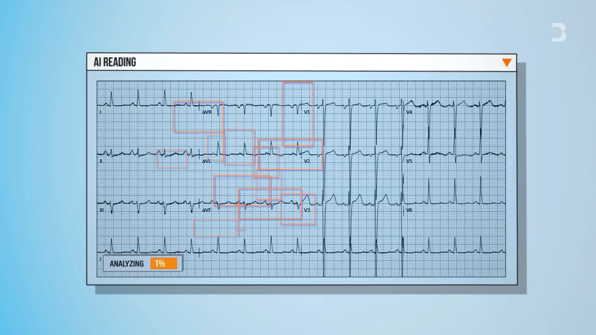 AI detecting heart failure from ECG