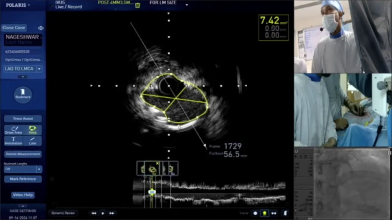 Complication management during PCI