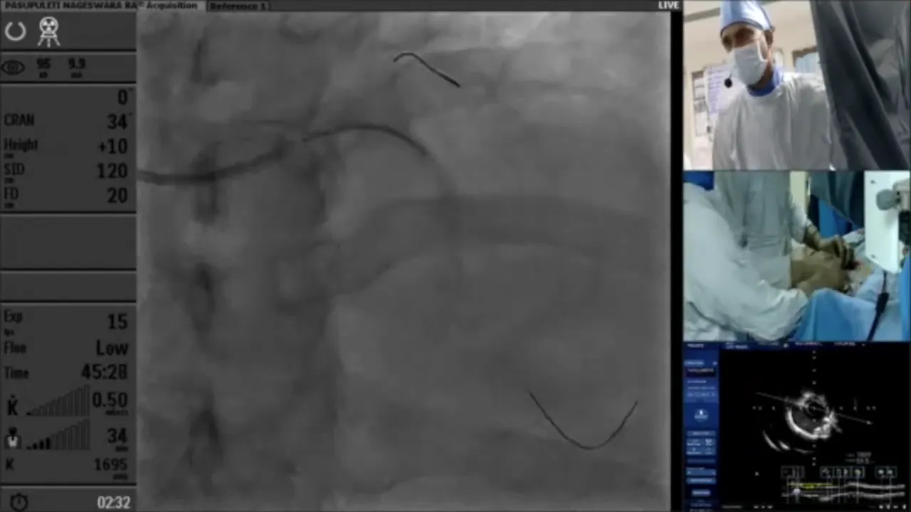 Final stent deployment process